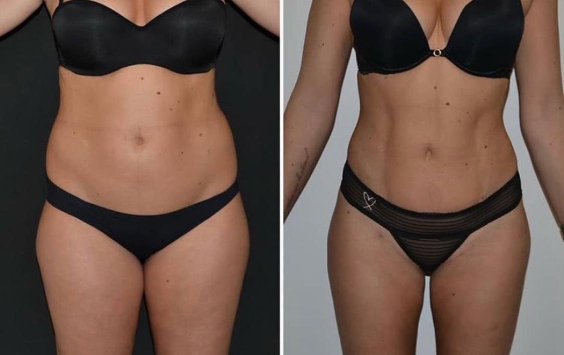 Antes y después SINERGIA